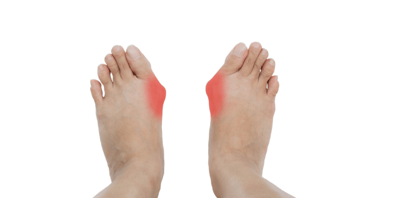 Bunion (hallux valgus)